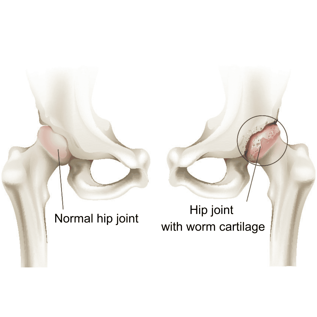 Hip Joint Surgery | Total Hip replacement Surgery - 香港